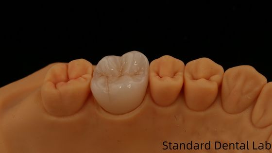 Noritake Porcellana Full Contour Corona di Zirconia Personalizzata Vita Shade per Estetica Restaurazione Dentale Digitale da Dental Lab