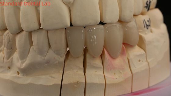 Corone di laboratorio dentale 3D Pro ad alta traslucidità Corone di zirconia completa con Vita Shade personalizzate