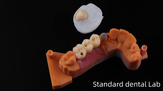 Post Core Dental Lab dalla Cina / Metal Post Core con corona PFM