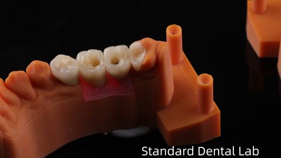Corona dell'impianto dentale a vite con porcellana stratificata di zirconia PFZ Garanzia di 5 anni e modello di stampa 3D