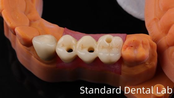 Impianto dentale di zirconio professionale Corona di titanio CAD CAM Corona di zirconio Laboratorio dentale cinese