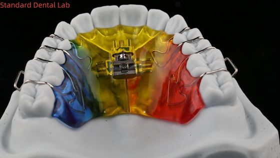 Espansione e distalizzazione dei denti Ortodontista Palate Expander Laboratorio dentale cinese