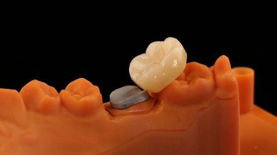 Corona di zirconia di contorno completo e alta estetica con nucleo di metallo 5 anni di garanzia e migliori tecnici del laboratorio dentale SDL