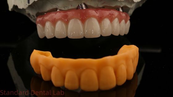 5 anni di garanzia Implantazione dentale Corona PMMA Ponte su Multi Unit Abutments Personalizzazione Vita Shade