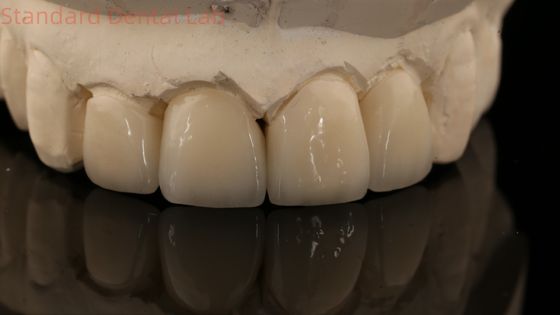 Corona e ponte di zirconia a strati forti in buona estetica Laboratorio dentale cinese a strati di zirconia
