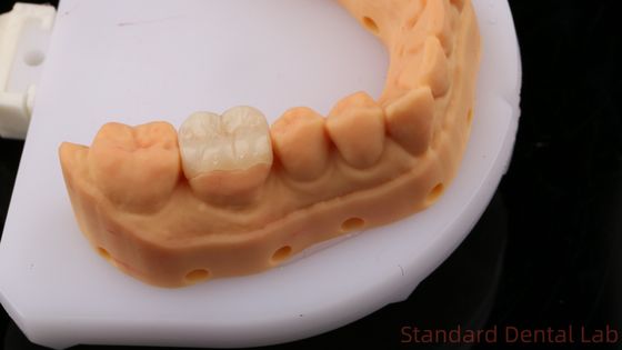 Intaglio dentale in zirconia traslucida Corona onlay per ripristinare la forma naturale della cavità / laboratorio dentale standard