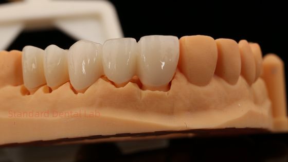 Denti anteriori altamente estetici di contorno completo Corona di zirconia con laboratorio dentale Vita Shade personalizzato