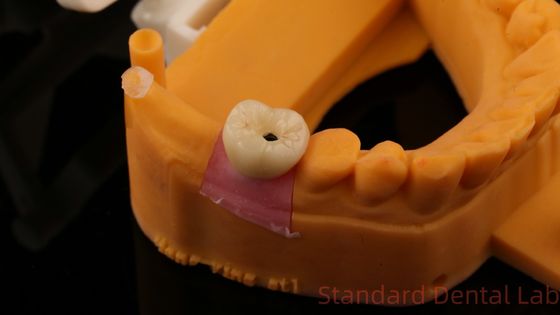 Impianto dentale a vite corona di porcellana stratificata PFZ con modello di stampa 3D