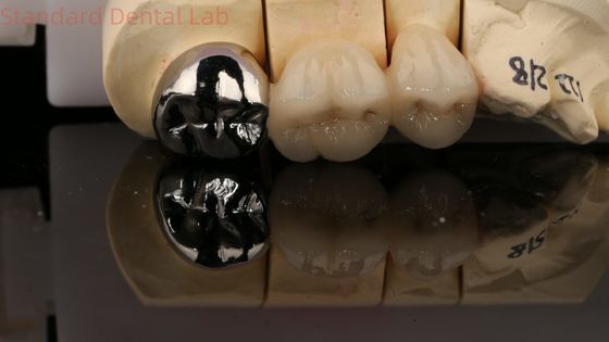 Corona in porcellana vita con post-core 3 anni di garanzia dal laboratorio dentale