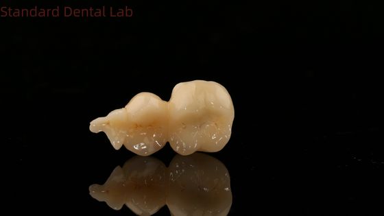 Dental Digital Full Zirconia Crown con 3D Print Model SDL Dental Lab Zirconia Onlay