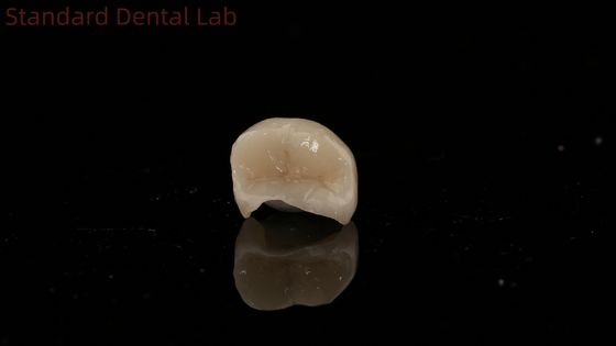 Corone dentale traslucida in zirconia Inlay Corona onlay per ripristinare la forma naturale della cavità