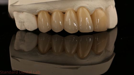 Noritake Porcellana di contorno completo Corona di zirconia alta estetica naturale Ponte dentale di zirconia personalizzata