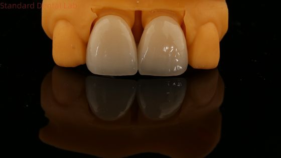 Garanzia di 5 anni Conto completo Corona di zirconia personalizzata Vita Ombra Alta estetica Ponte dentale naturale