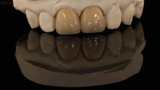 Corona di zirconia a contorno completo e ponte dentale naturale di alta estetica Garanzia di 5 anni