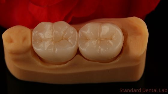 Corona di zirconio di contorno completo Struttura e estetica eccezionali Nessuna sovrapposizione in porcellana Corona posteriore Laboratorio odontoiatrico cinese