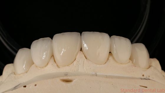 Ponte di corona in zirconia di precisione Comodo / estetica 3-4 giorni Tempo di consegna rapido