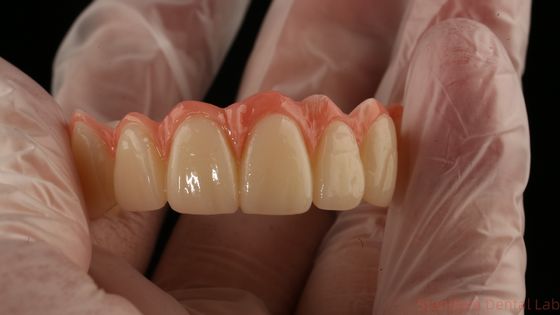 Porcellana tutto su quattro Ponte di zirconia Ponte di impianti dentali di alta estetica