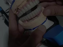 Ponte Malo ibrido Zirconia tutto su quattro / sei Zirconia ponte impianto Titania barra