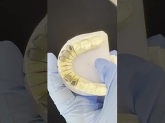 Metallo Cast Post Core Crown Cocr Accurate Retentive Full Zirconia Bruxier