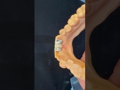 Dental Teeth PFM Maryland Bridge Alta estetica Certificato FDA